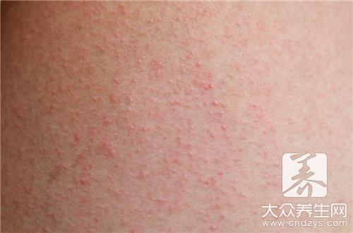 湿疹能吃什么鱼 